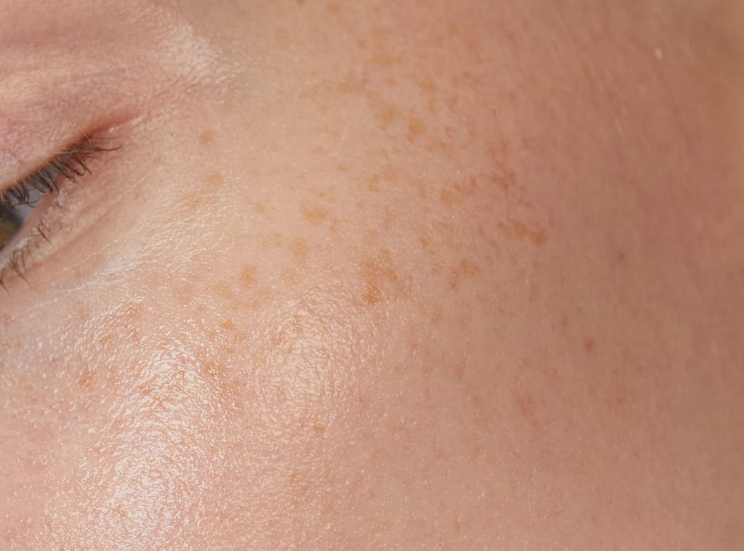 Dive deep into the Cause of Hyperpigmentation